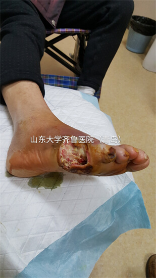 赵女士穿鞋不当致脚汗湿后引起糖尿病足，伤口三年未愈！